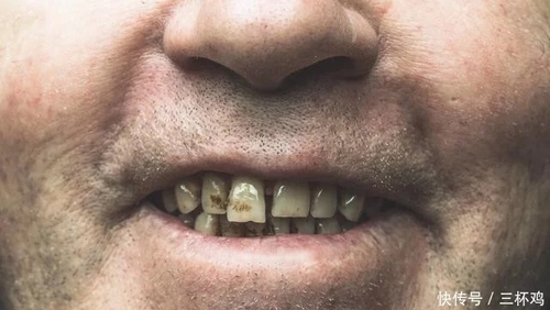 晚情园地：服务平台：牙不好心脏病风险增加！请爱护我们的牙齿！7、.webp